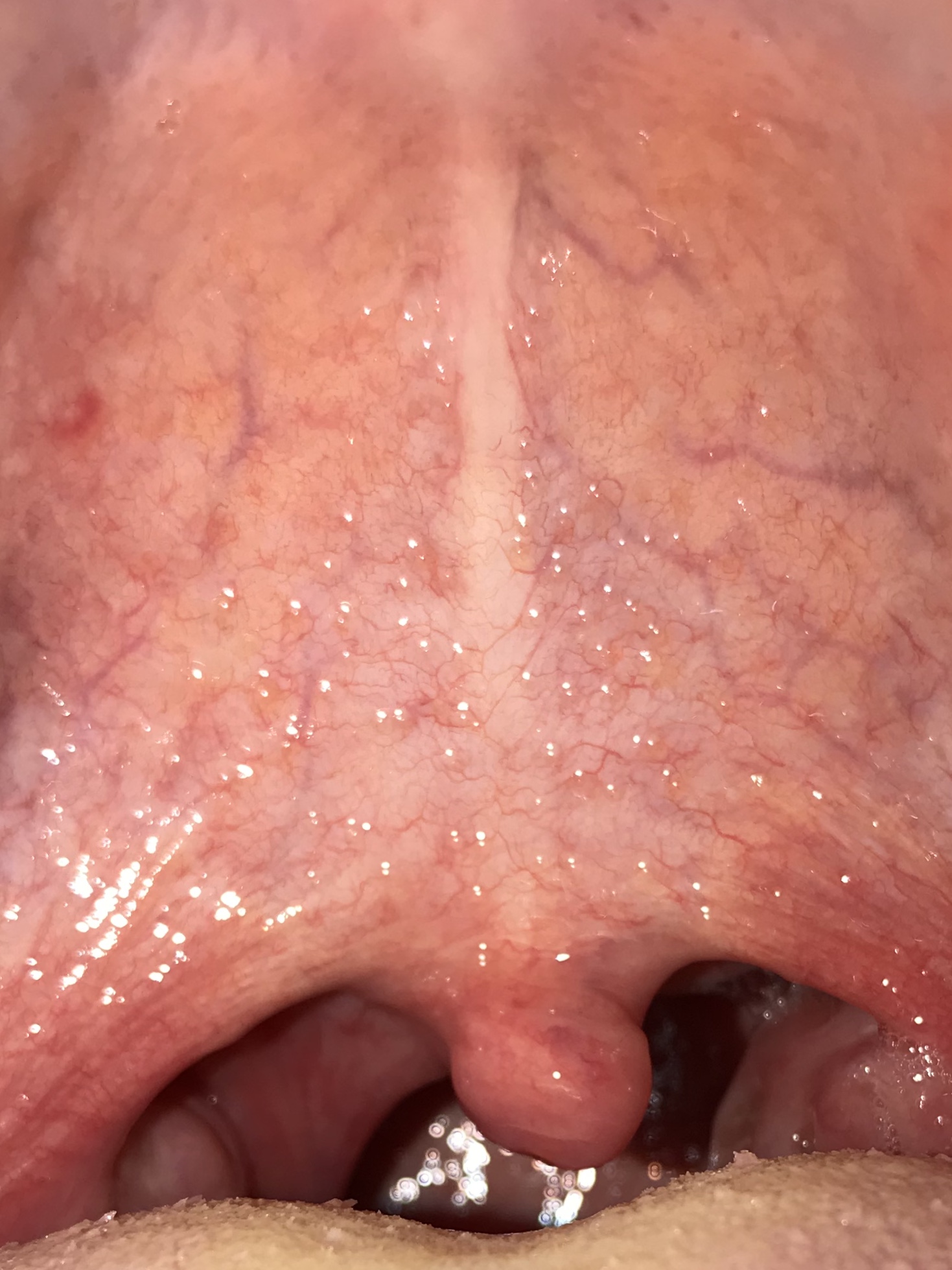 Was ist die Ursache von Bläschen auf dem Gaumen/Rachen? (Gesundheit und Was ist die Ursache von Bläschen auf dem Gaumen/Rachen? (Gesundheit und