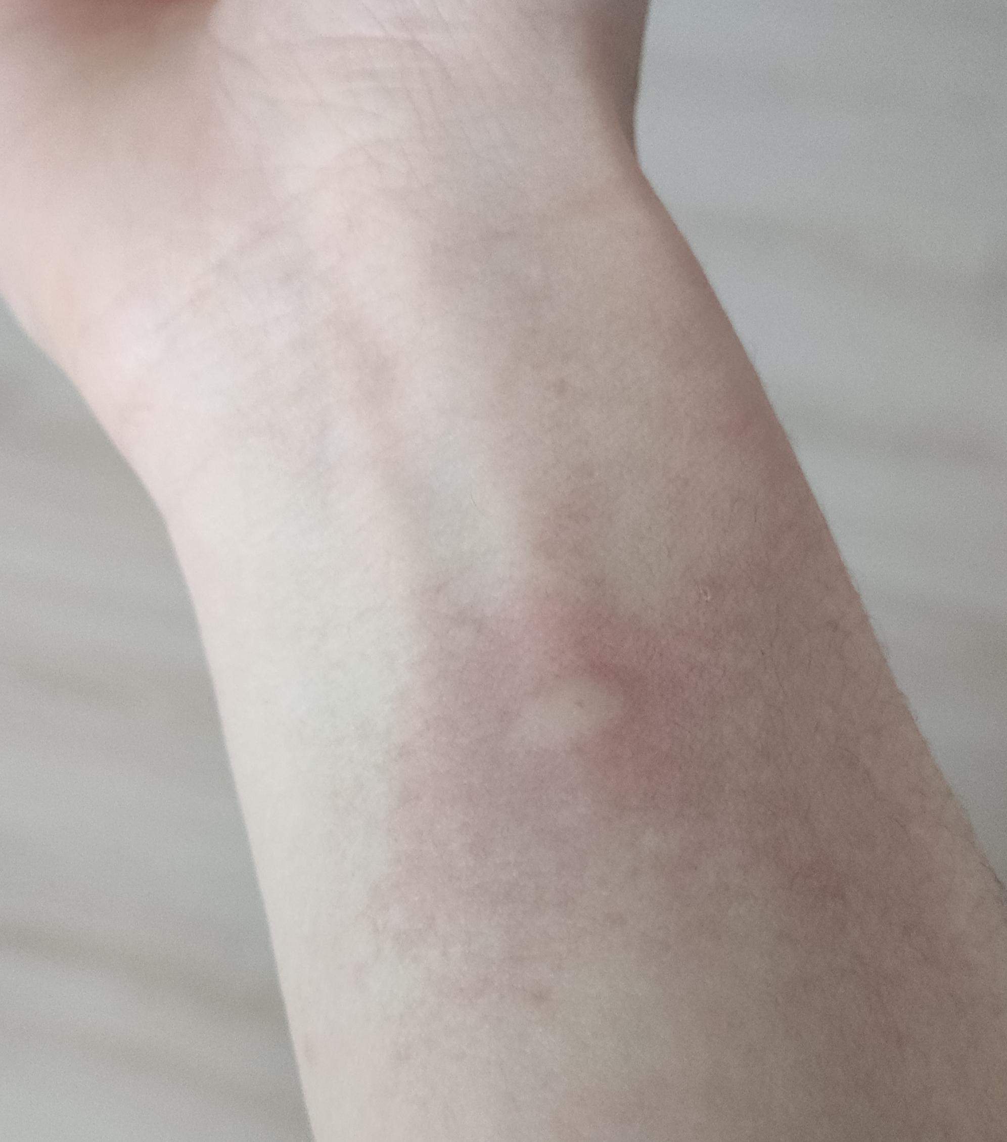 Was ist diese Blase am Arm? (Gesundheit und Medizin, Gesundheit, Körper)