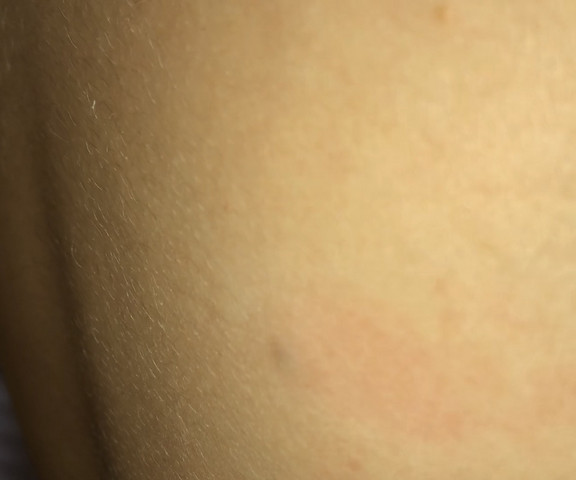 Was Ist Diese Dunkle Stelle Unter Der Haut Veranderung Was Ist Diese Dunkle Stelle Unter Der Haut Veranderung