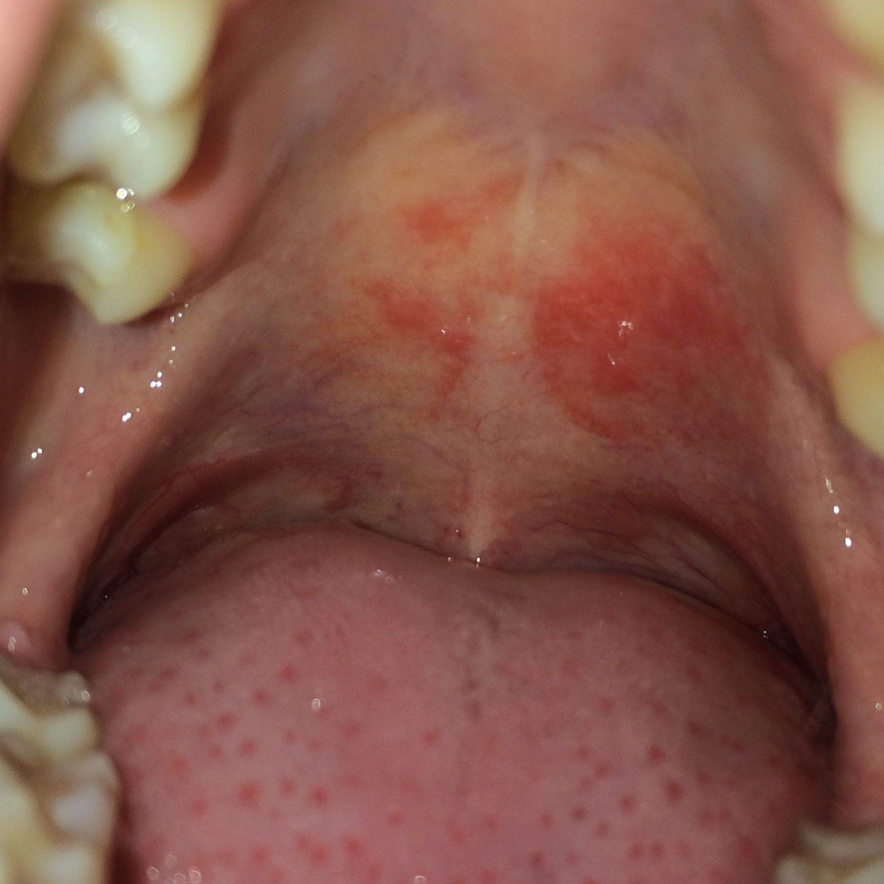 Was ist diese gelblich rote Stelle am Gaumen? (Gesundheit und