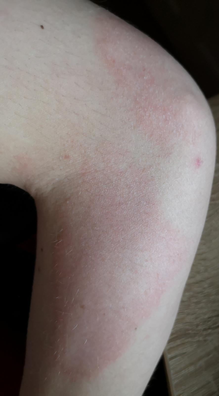 36++ Rote flecken am arm bilder , Was ist diese rote große Fläche an meinem Arm? (Gesundheit und Medizin