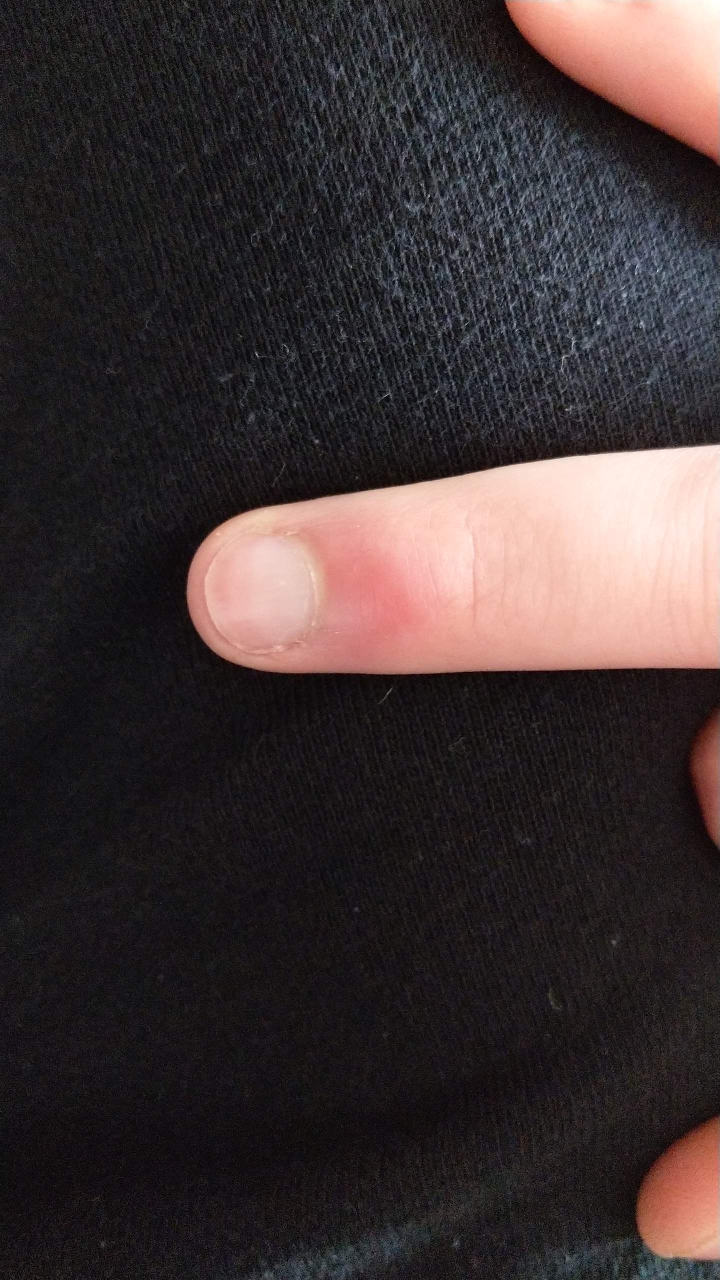 Was ist diese Schwellung an meinem Finger? (Gesundheit und Medizin ...