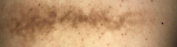 Was Ist Dieser Braune Fleck Am Rucken Gesundheit Und Medizin Gesundheit Haut Was Ist Dieser Braune Fleck Am Rucken Gesundheit Und Medizin Gesundheit Haut