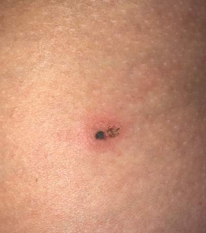 Was Ist Dieser Schwarze Fleck Gesundheit Und Medizin Gesundheit Wunde Was Ist Dieser Schwarze Fleck Gesundheit Und Medizin Gesundheit Wunde