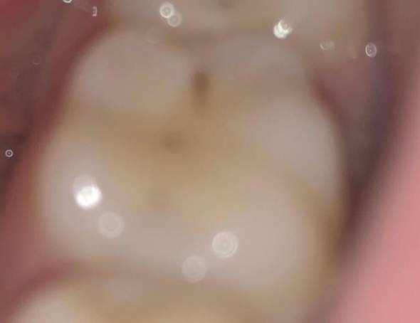 Was ist dieser schwarze Punkt auf meinem Zahn bin 17 und der tut verdammt weh wenn ich nicht alle 2 Stunden mit der Zahnbürste drüber gehe?