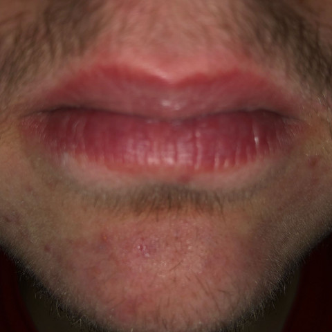 Verfärbung um Lippen - (Gesundheit und Medizin, Beauty, Tipps)