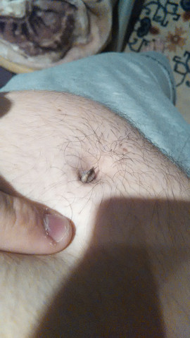 Was Ist In Meinem Bauchnabel Stinkt Und Ist Schwarz Weiss Soll Ich Ins Krankenhaus Gehen Arzt Hygiene Entzundung Was Ist In Meinem Bauchnabel Stinkt Und Ist Schwarz Weiss Soll Ich Ins Krankenhaus Gehen Arzt Hygiene Entzundung