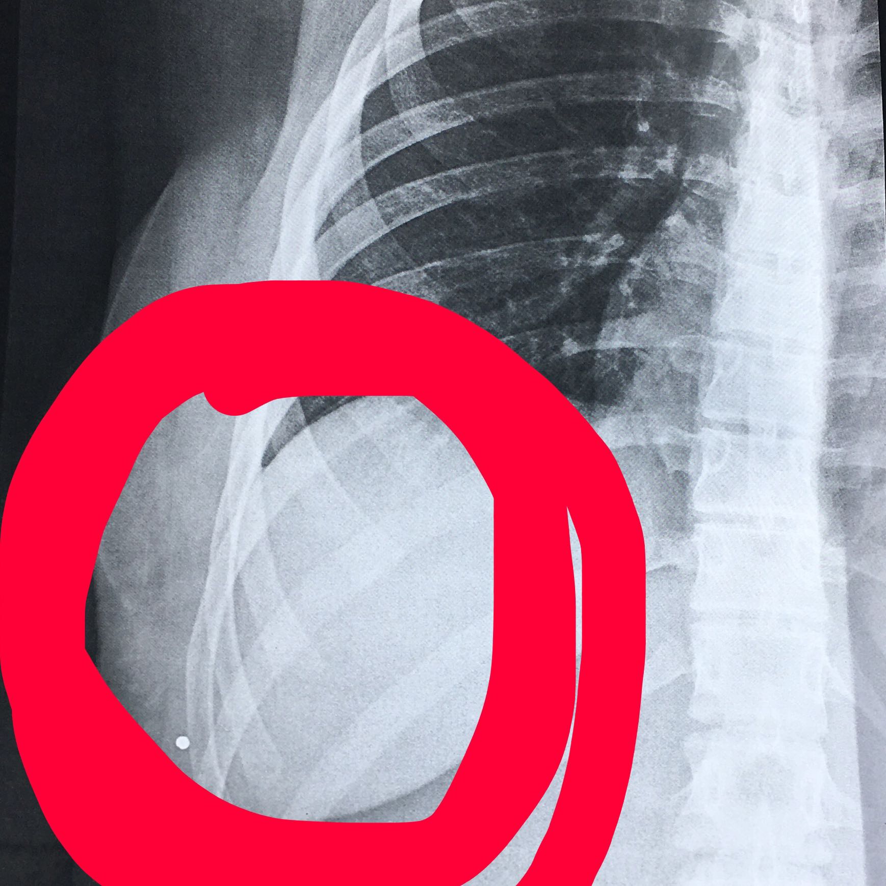 Was Ist Mit Dieser Rippe Falsch Gebrochen Arzt Schmerzen Unfall Was Ist Mit Dieser Rippe Falsch Gebrochen Arzt Schmerzen Unfall