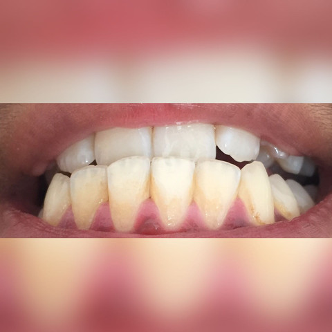 Das komische ist, dass nur meine unteren Zähne so sind, meine oberen sind weiß - (Zähne, Zahnarzt, Zahnfleisch)