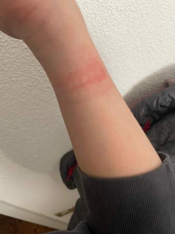 Was ist mit meinem Arm passiert?