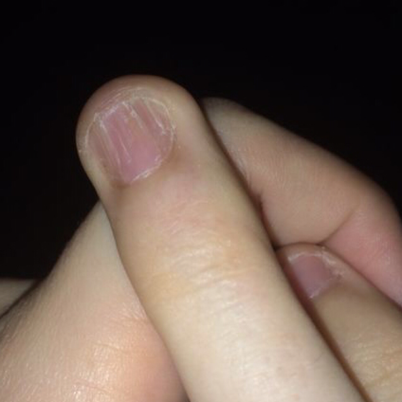 Finger In Tür Eingeklemmt Nagel Blau