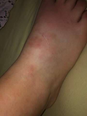 Was Ist Mit Meinem Fuss Fuss Gebrochen
