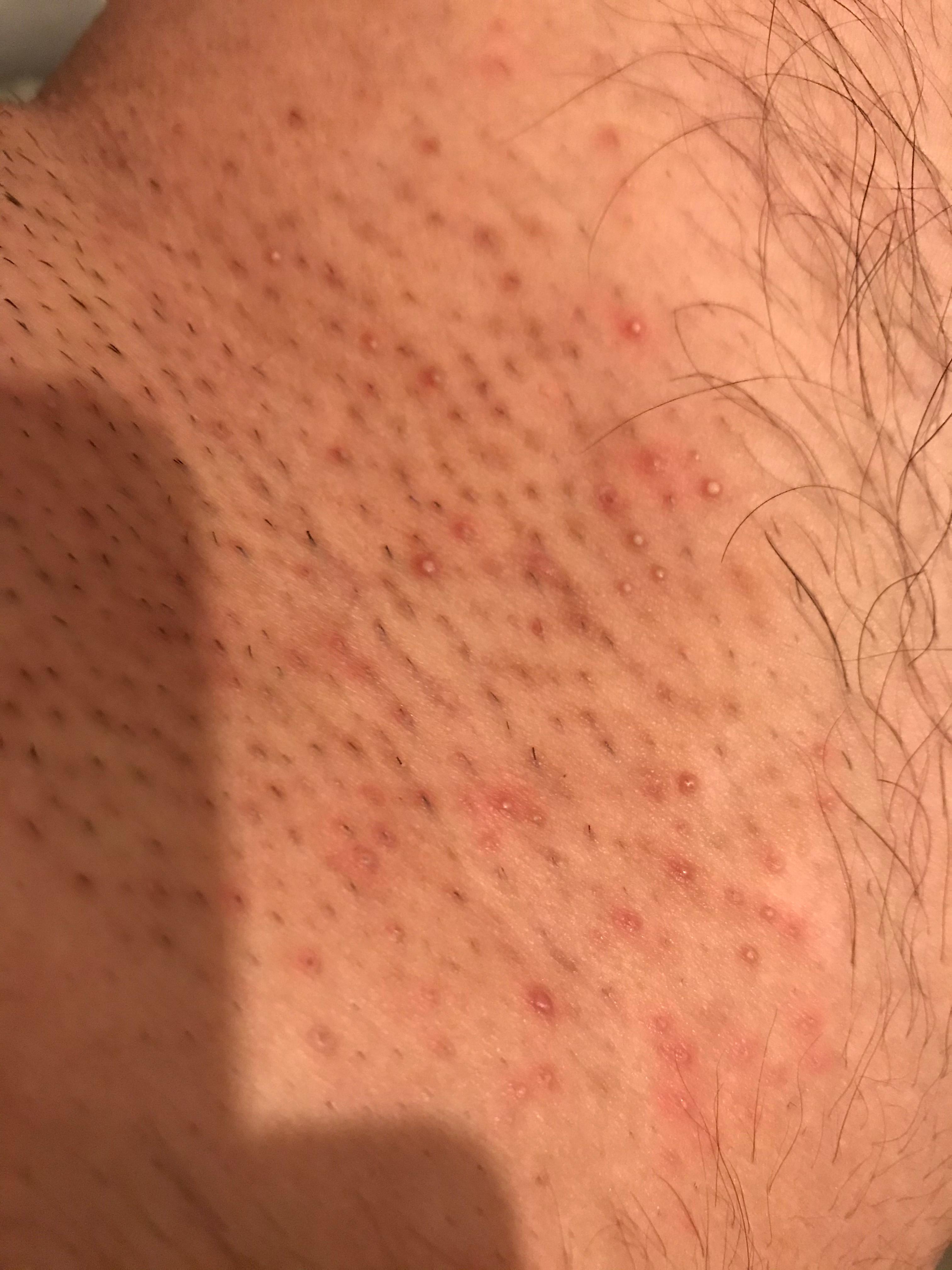 rasierpickel intimbereich rasieren