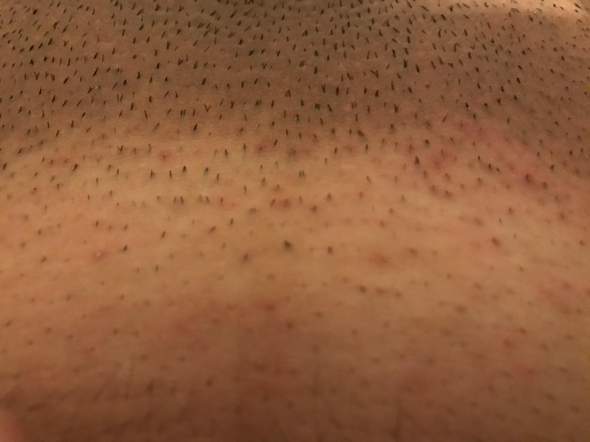 rasierpickel intimbereich rasieren