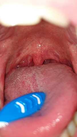 Was Ist Mit Meinem Rachen Los Gesundheit Und Medizin Krankheit Hals Was Ist Mit Meinem Rachen Los Gesundheit Und Medizin Krankheit Hals