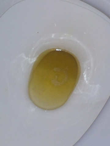 Fetzen im urin