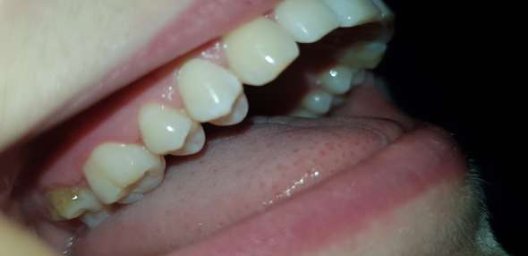 Was Ist Mit Meinem Zahn Falsch Gesundheit Und Medizin Zahne Zahnspange