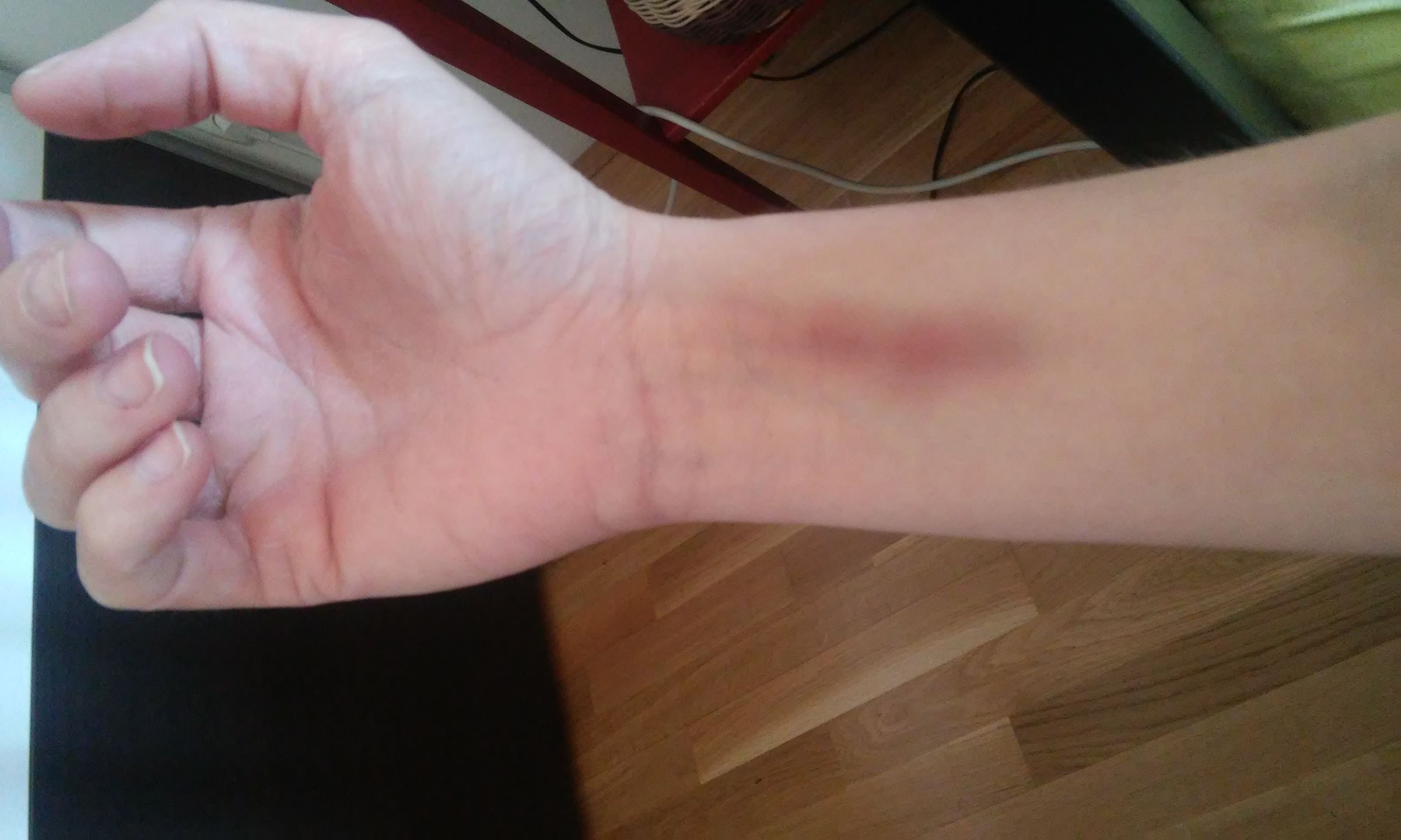 Was ist mit meinen Adern los. Muss ich zum Arzt? (blutabnahme, Ader)