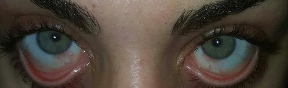 Augen - (Augen, EntzÜndung, Antibiotika)