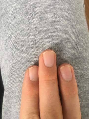 Was ist mit meinen Fingernägeln los?