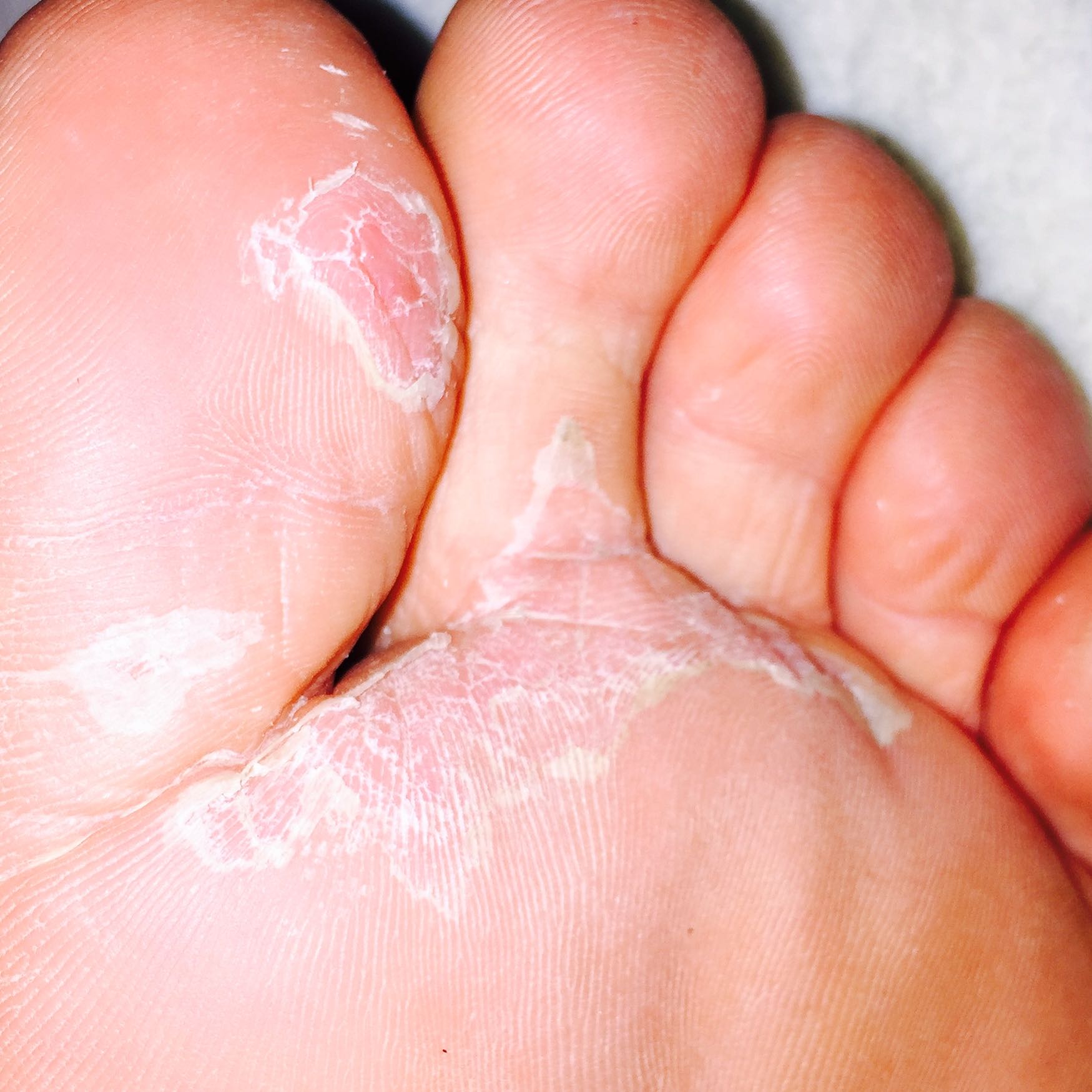 Was ist mit meinen Füssen los? (Füße, trocken, Fußpflege)