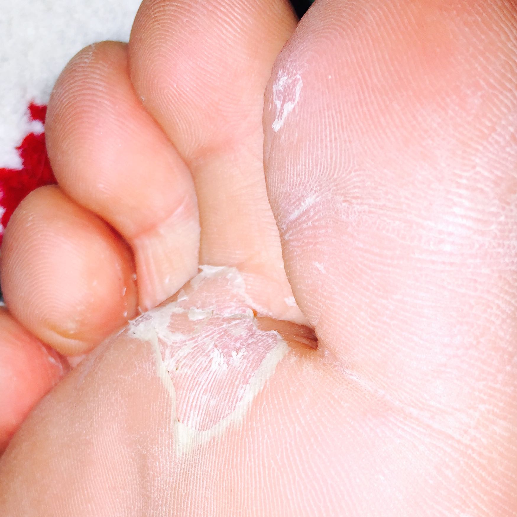 Was ist mit meinen Füssen los? (Füße, trocken, Fußpflege)