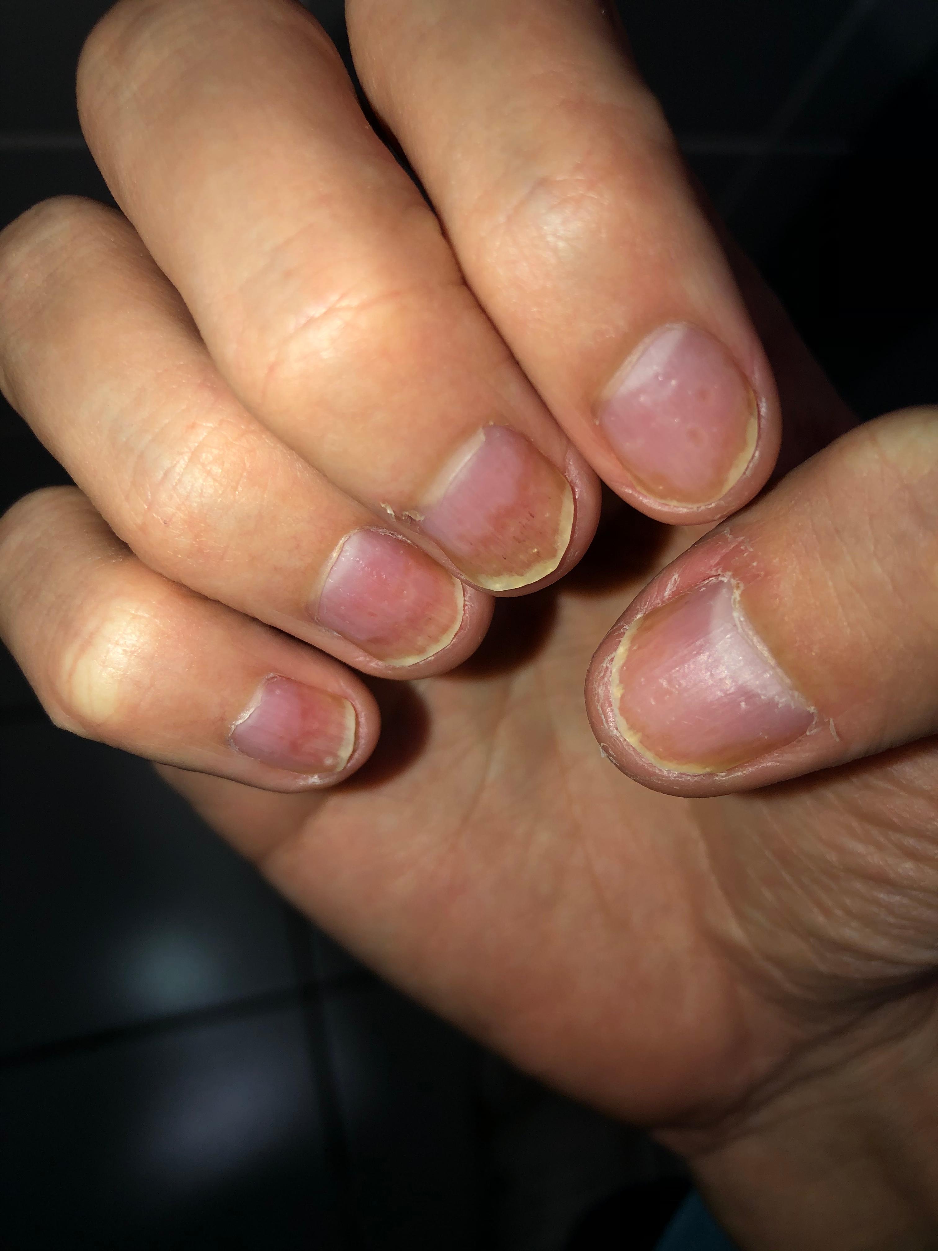 Was Ist Mit Meinen Nageln Los Haut Nagel Fingernagel