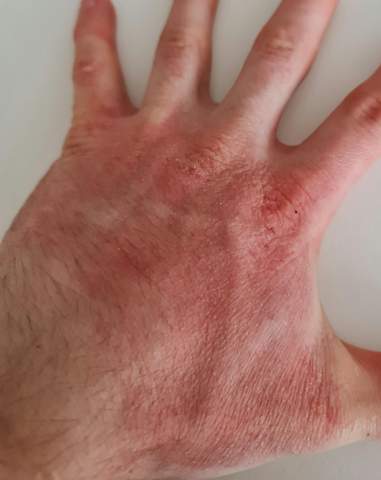 Was ist mit meiner Hand, welche Krankheit?