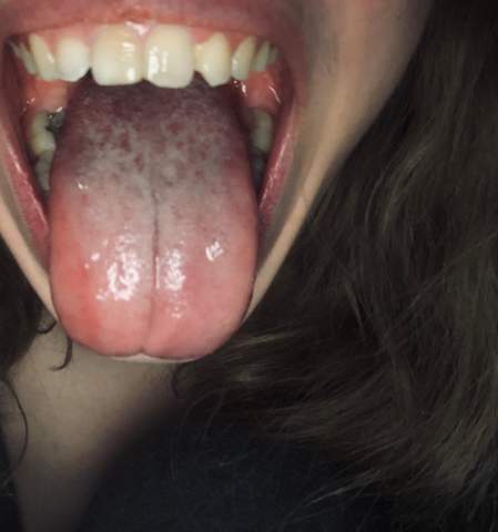 Was ist mit meiner Zunge ( Pilz Allergie? (Gesundheit und Medizin, Mund)