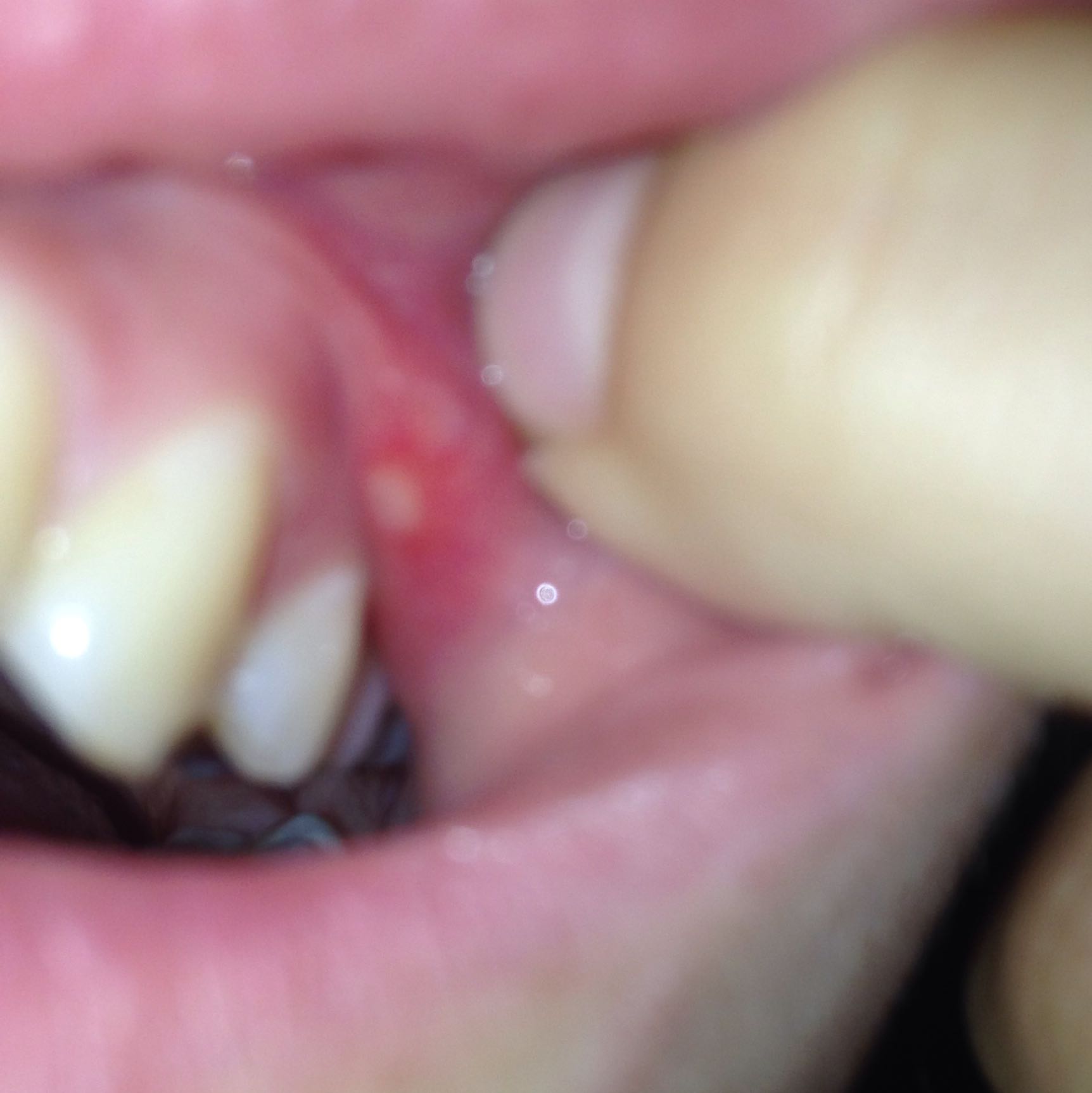 Was Ist Das In Meinem Mund Zahne Pickel Zahnarzt