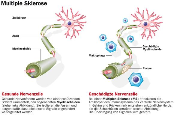 Rechte Nervenzelle - (Krankheit, Biologie, Bio)