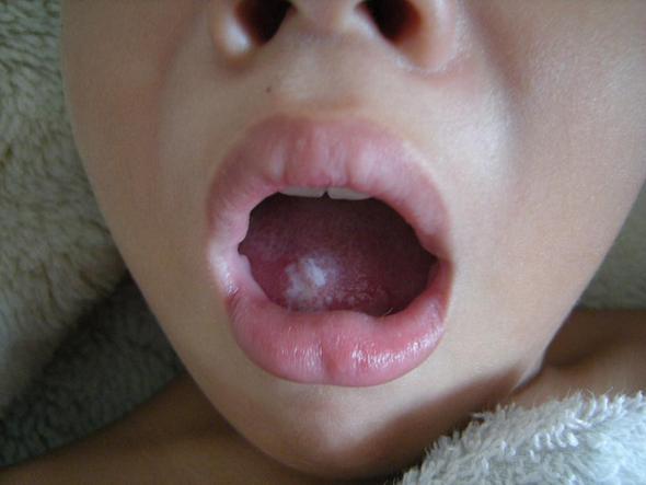 etwas auf der Zunge - (Krankheit, Kinder)
