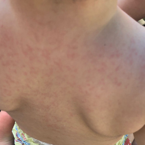 Was Kann Das Sein Allergie Gesundheit Und Medizin Kinder Baby Was Kann Das Sein Allergie Gesundheit Und Medizin Kinder Baby