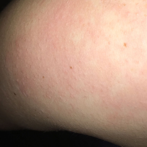 Was Kann Das Sein Arm Schulter Nacken Haut Pickel Allergie