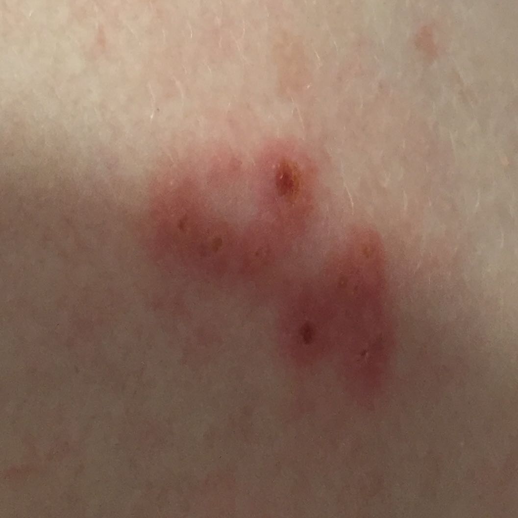 Was kann das sein? Gürtelrose? (Pickel, Rücken, Flecken)