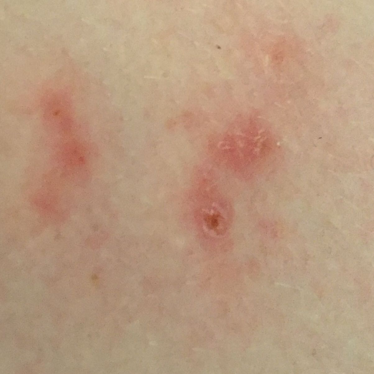 Was kann das sein? Gürtelrose? (Pickel, Rücken, Flecken)