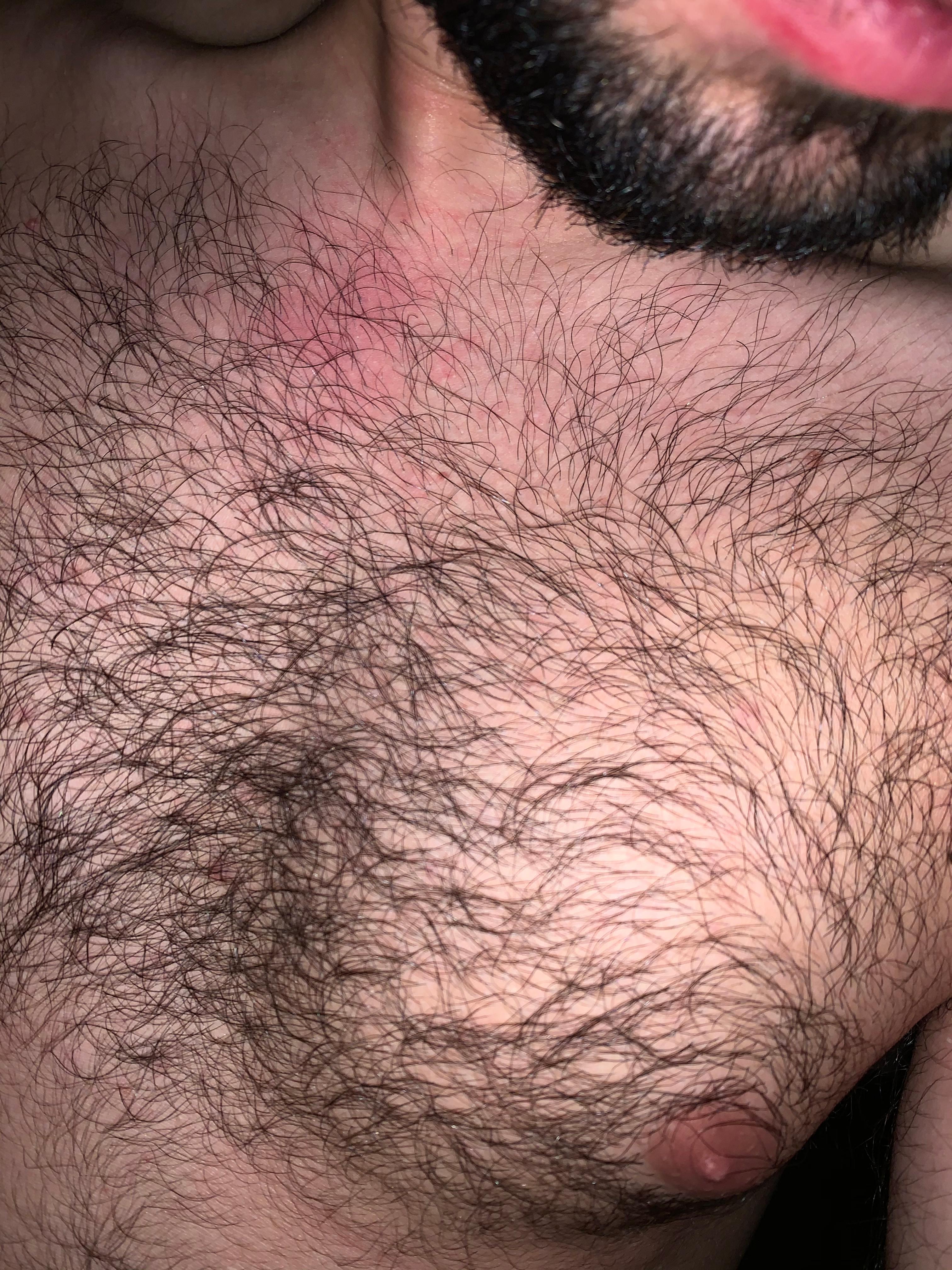 Was kann das sein habe das seit paar tagen auf meiner brust Was kann das sein habe das seit paar tagen auf meiner brust