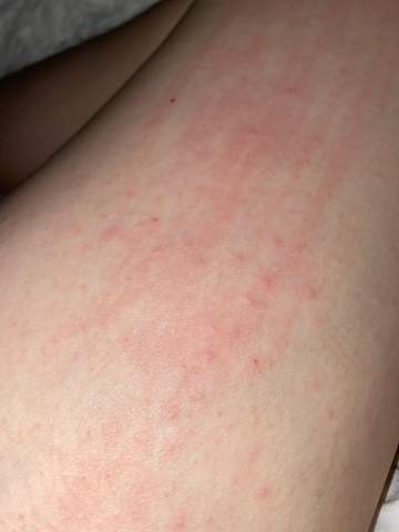 Was Kann Das Sein Ich Brauch Eure Hilfe Juckreiz Juckende Haut Was Kann Das Sein Ich Brauch Eure Hilfe Juckreiz Juckende Haut
