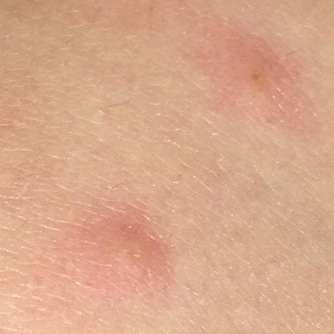 Was kann das sein? Ist es evtl etwas schlimmes????? (Pickel, jucken) pickel jucken