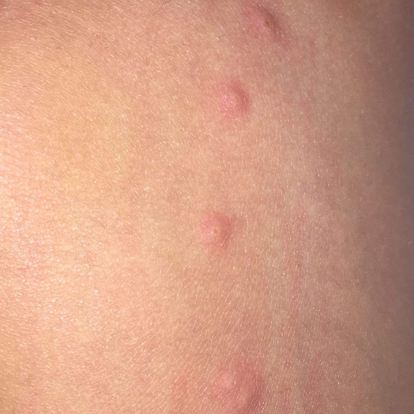 Was kann das sein? Ist es evtl etwas schlimmes????? (Pickel, jucken) pickel jucken