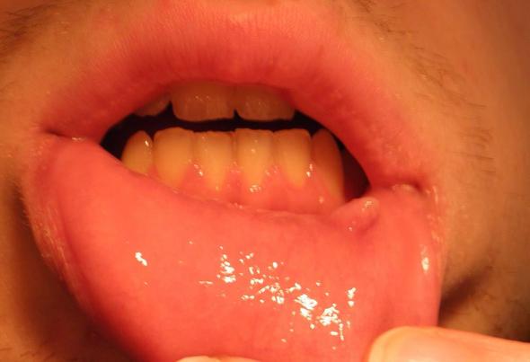 Was Kann Das Sein Knubbel An Der Lippe Gesundheit Arzt Was Kann Das Sein Knubbel An Der Lippe Gesundheit Arzt