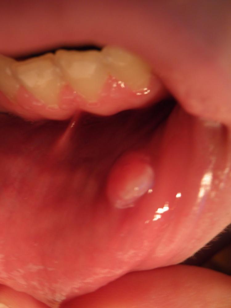 Was Kann das sein? Knubbel an der Lippe! (Gesundheit, Arzt) Was Kann das sein? Knubbel an der Lippe! (Gesundheit, Arzt)