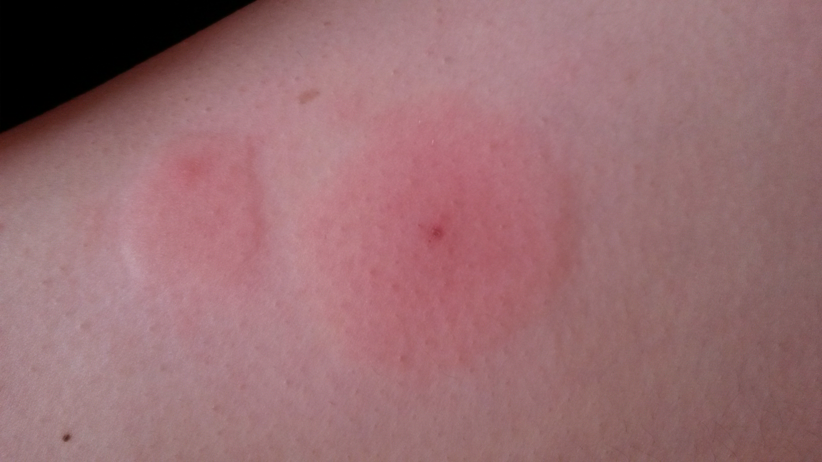 Was kann das sein? Mückenstich oder Zeckenbiss? (mueckenstich)