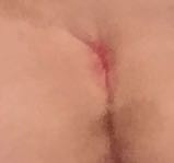 Beschreibt mein Problem und die komische rote Beule , die ziemlich weh tut . - (Schmerzen, rot, Dick)