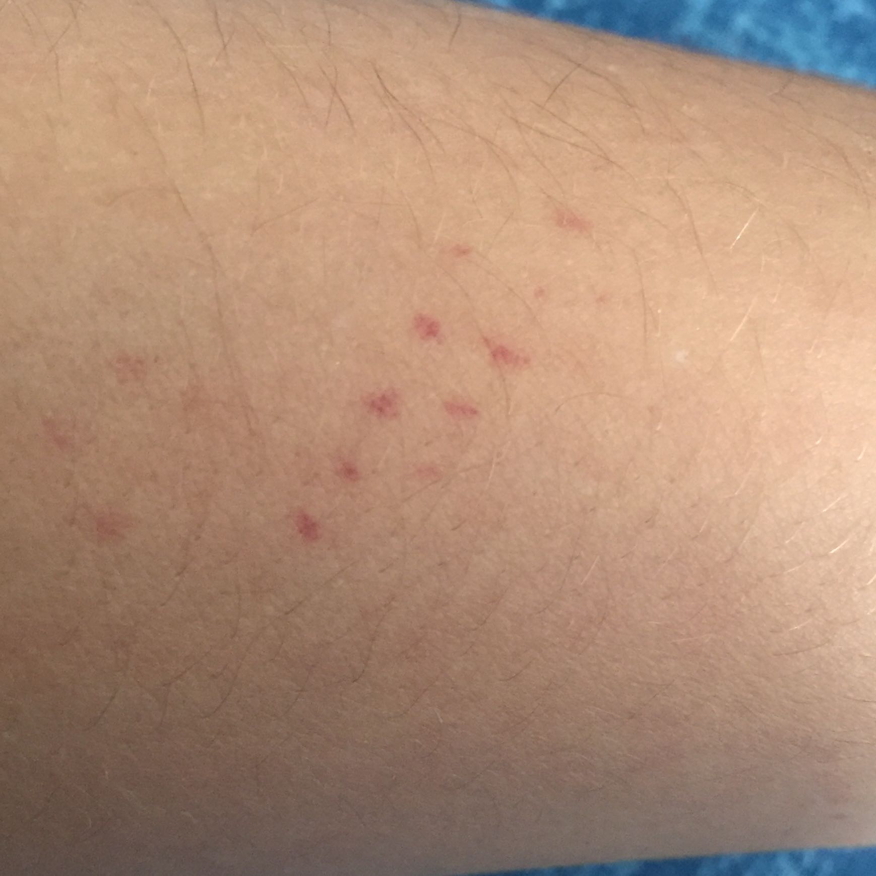 Was kann das sein (so eine Art Ausschlag am Arm) siehe Bilder? (Arzt Was kann das sein (so eine Art Ausschlag am Arm) siehe Bilder? (Arzt