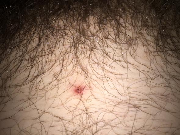 Im bereich warze intim Kleine Warze