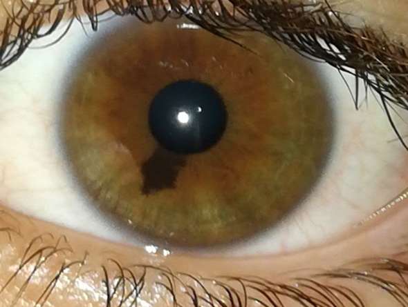 Was Kann Das Sein Pupille Gesundheit Und Medizin Augen Optik Was Kann Das Sein Pupille Gesundheit Und Medizin Augen Optik