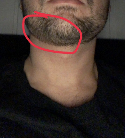Was Kann Das Unter Meinem Kinn Sein Seit Neuem Bemerkt Gesundheit Medizin Krebs Was Kann Das Unter Meinem Kinn Sein Seit Neuem Bemerkt Gesundheit Medizin Krebs