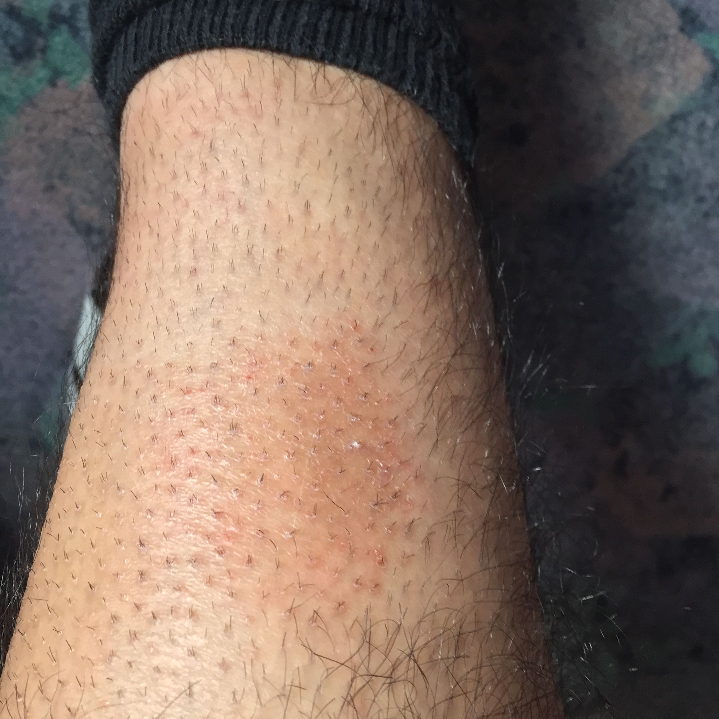Was kann diese leichte braune/ Rötung am Schienbein sein? (Gesundheit