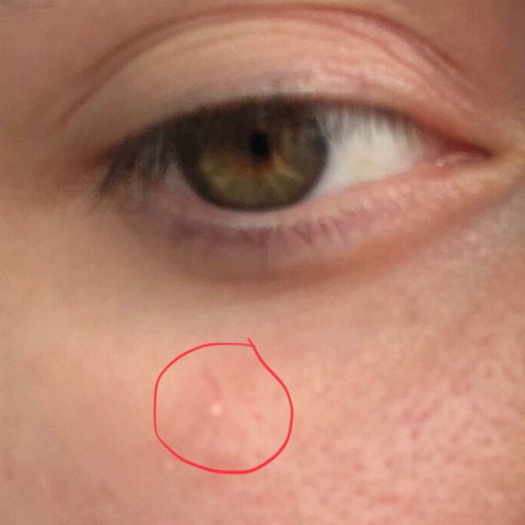 Was Kann Dieser Weisse Fleck Unterm Auge Sein Gesundheit Und Medizin Medizin Haut